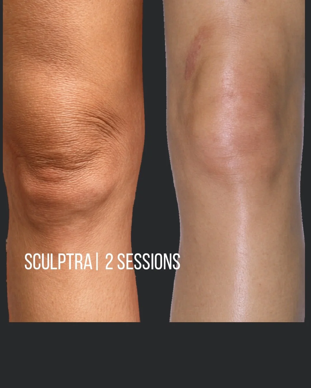 Side-by-side comparison of a knee before and after two sculpting sessions, showing improved skin smoothness and reduced sagging.