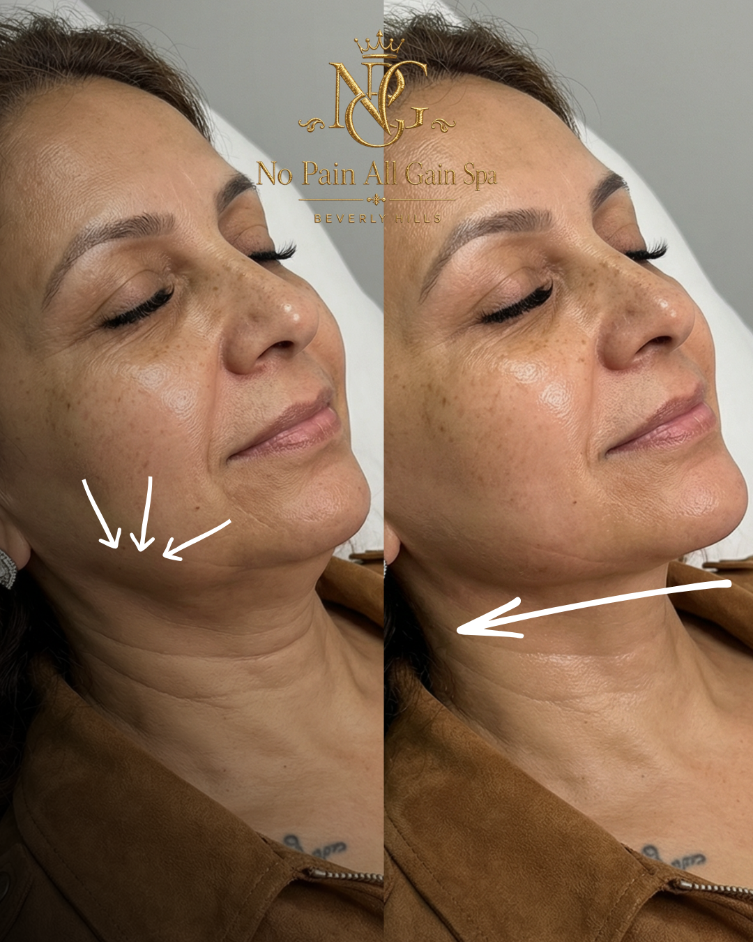 Before and after comparison of a woman's face and neck, showing improvements in skin texture and reduction of wrinkles after a spa treatment at No Pain All Gain Spa Beverly Hills.