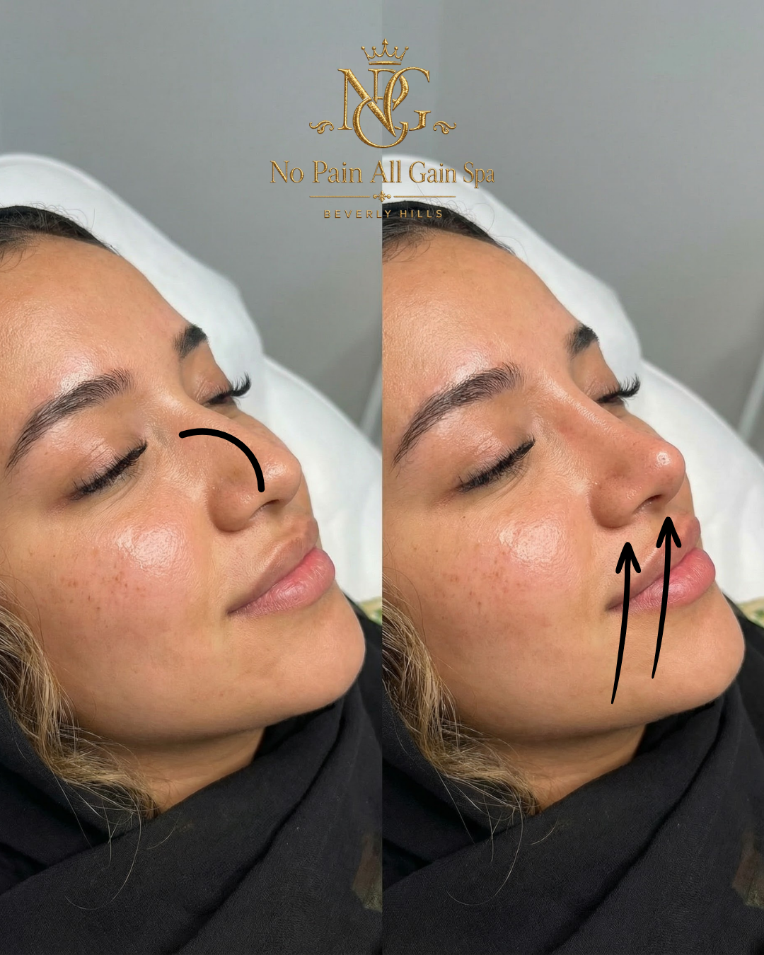 Side-by-side comparison of a woman receiving a non-invasive facial treatment. The left side shows her nose with a curved arrow indicating a lifting or shaping process, and the right side shows her nose with upward arrows suggesting a lifting or enhan