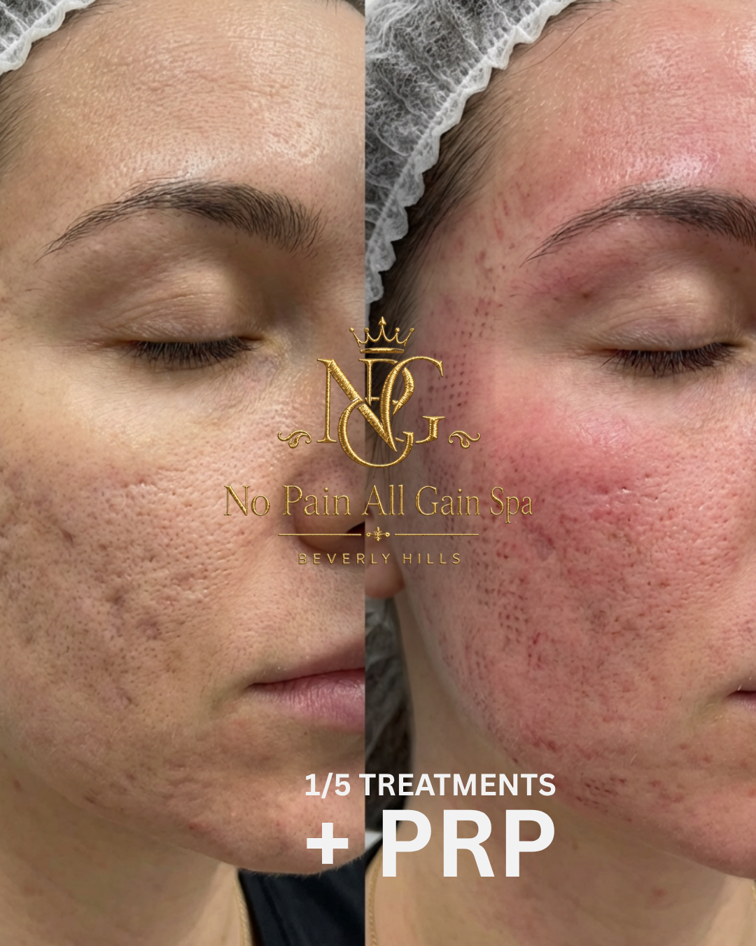 Comparison of a woman's face before and after skin treatment showing improved skin texture and reduced acne scars, with text indicating it's from a spa offering treatments including PRP in Beverly Hills.