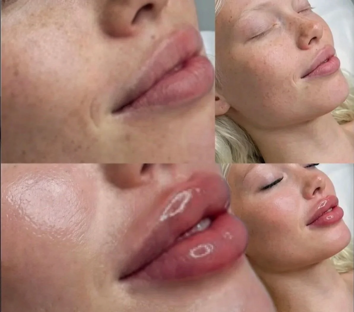 Close-up of a woman's face showing before and after skin treatment, highlighting improvements in skin texture, lips, and overall appearance.