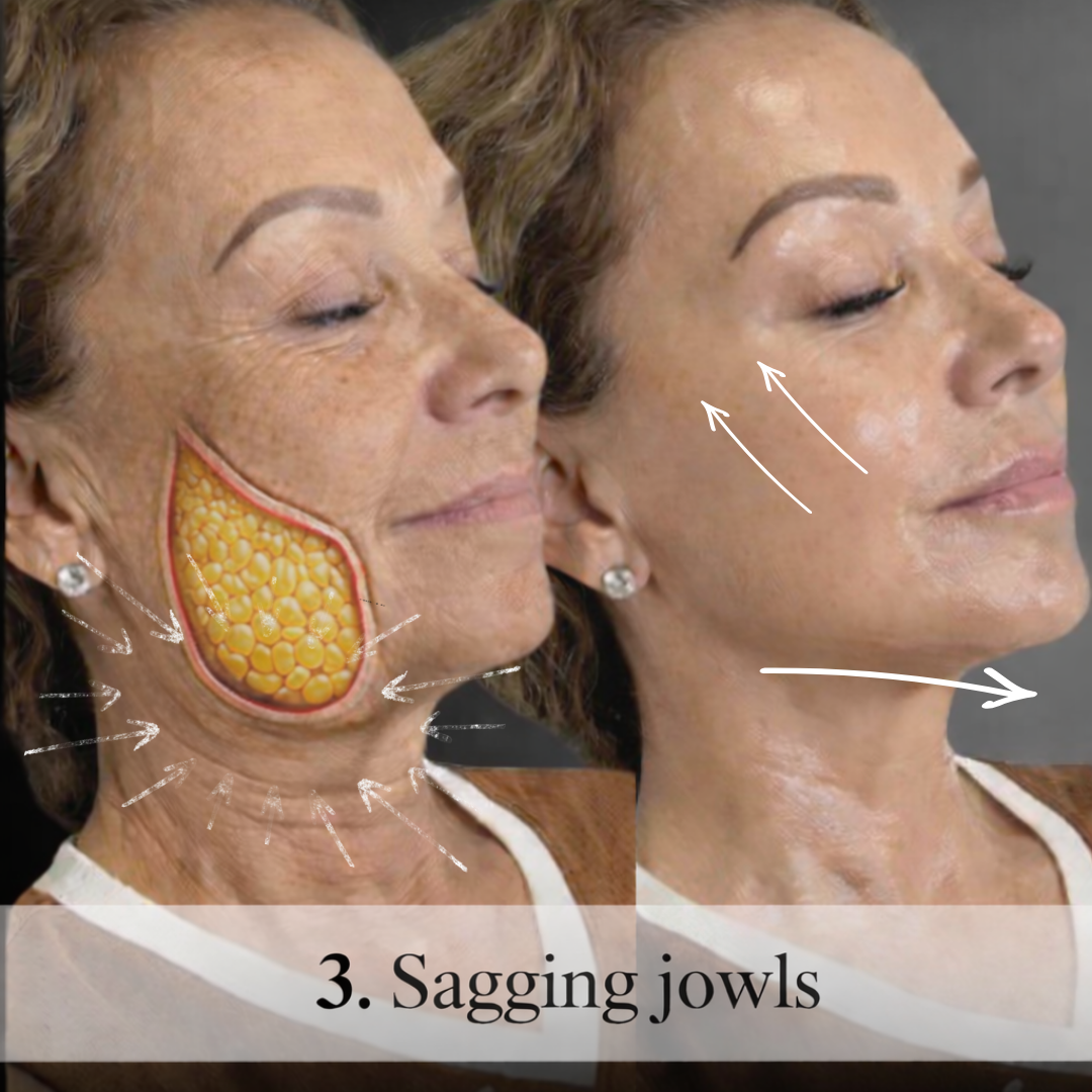 POST+JAWLINE%26CHIN+FILLER+COMBO-STORIES+%28Instagram+Post+%2845%29%29+-+4.png