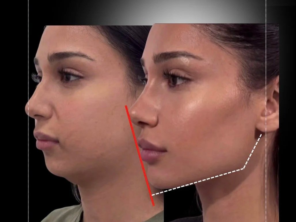 Side-by-side comparison of a woman's face before and after a cosmetic procedure, with facial measurement lines.