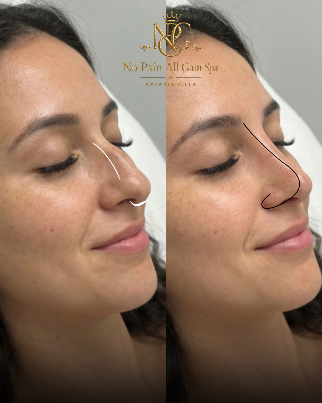 Side-by-side comparison of a woman's nose before and after a cosmetic procedure, showing a reduction in the dorsal hump. The left image shows the nose before, with a slight bump, and the right image shows the nose after, with a smoother and straighte