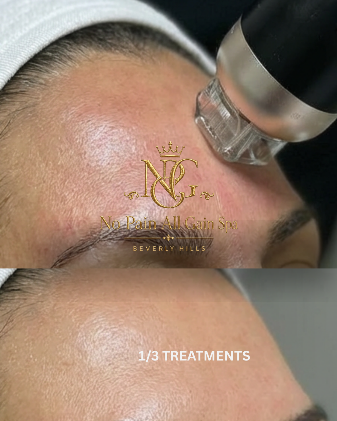 A person receiving a facial treatment, with a close-up of their forehead showing improved skin appearance after one-third of treatment sessions at No Pain All Gain Spa in Beverly Hills.