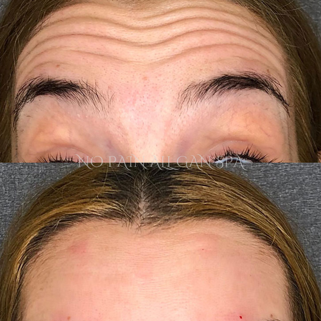 Close-up comparison of a person's forehead before and after a cosmetic treatment, showing reduction of wrinkles and improved skin smoothness.