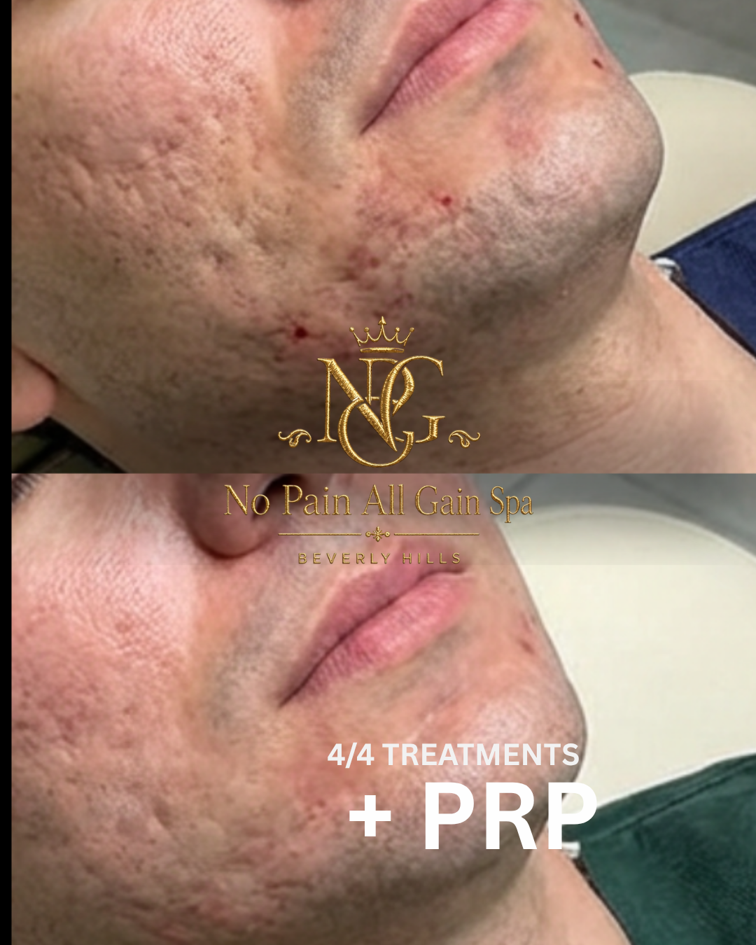 Comparison of face before and after skin treatments showing reduced acne scars and improved skin texture after four treatments and PRP at No Pain All Gain Spa in Beverly Hills.