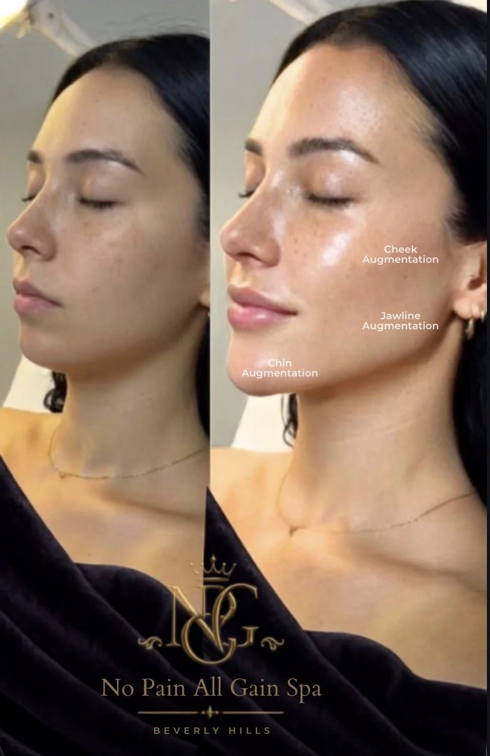 Side-by-side images of a woman's face before and after cosmetic augmentation, with labels pointing to cheek, jawline, and chin enhancements.