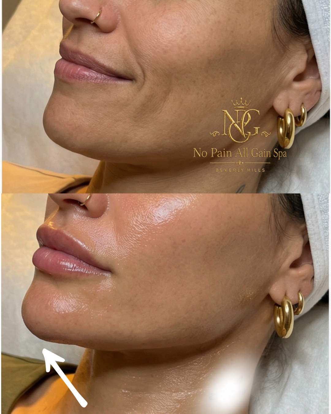 Before and after images of a woman's face showing a reduction in skin imperfections and enhanced glow following a spa treatment at No Pain All Gain Spa in Beverly Hills.