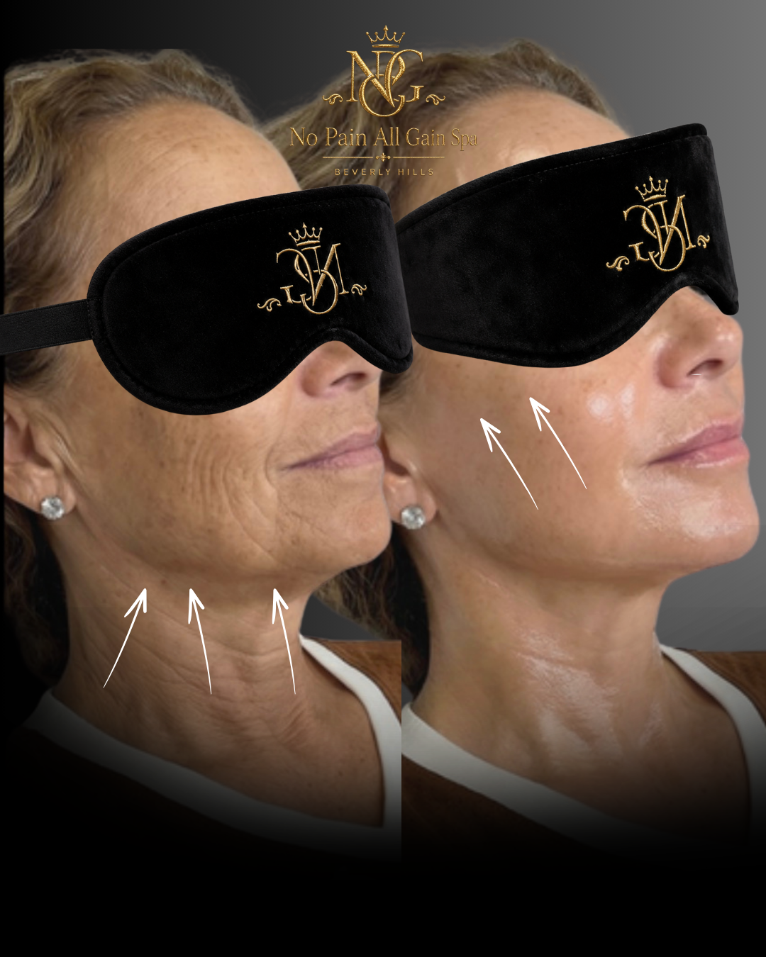 Side-by-side comparison of a woman's face before and after skincare, with black sleep mask covering her eyes in both images, promoting a spa service at No Pain All Gain Spa, Beverly Hills.