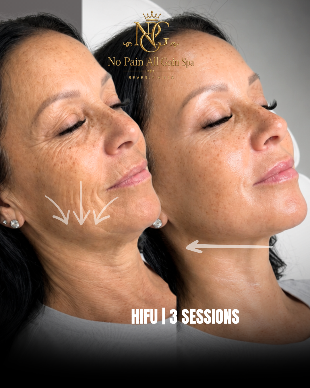 Before and after images of a woman's face showing improved skin texture and reduced wrinkles following 3 sessions of HIFU treatment at No Pain All Gain Spa in Beverly Hills.