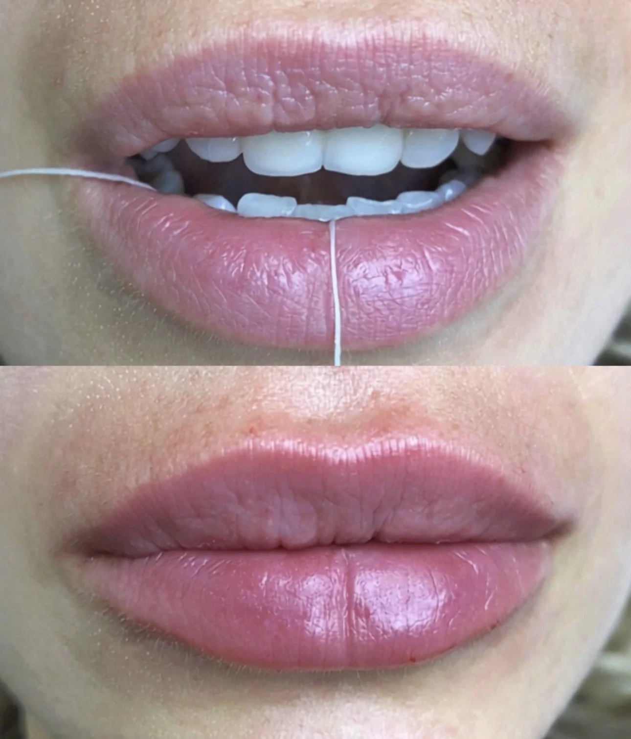 Close-up of a person's mouth showing before and after dental cleaning or whitening, with lips slightly parted in the top image revealing teeth, and lips closed in the bottom image.