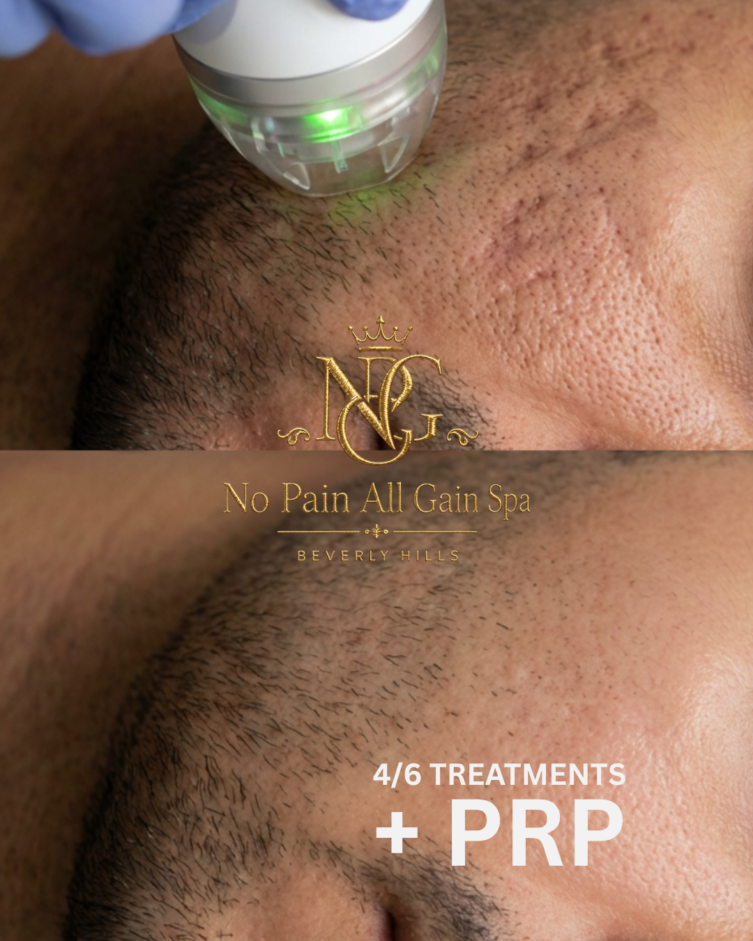 Close-up of black man's face getting laser treatment on the eyebrow area at No Pain All Gain Spa in Beverly Hills, with all skin pores visible.