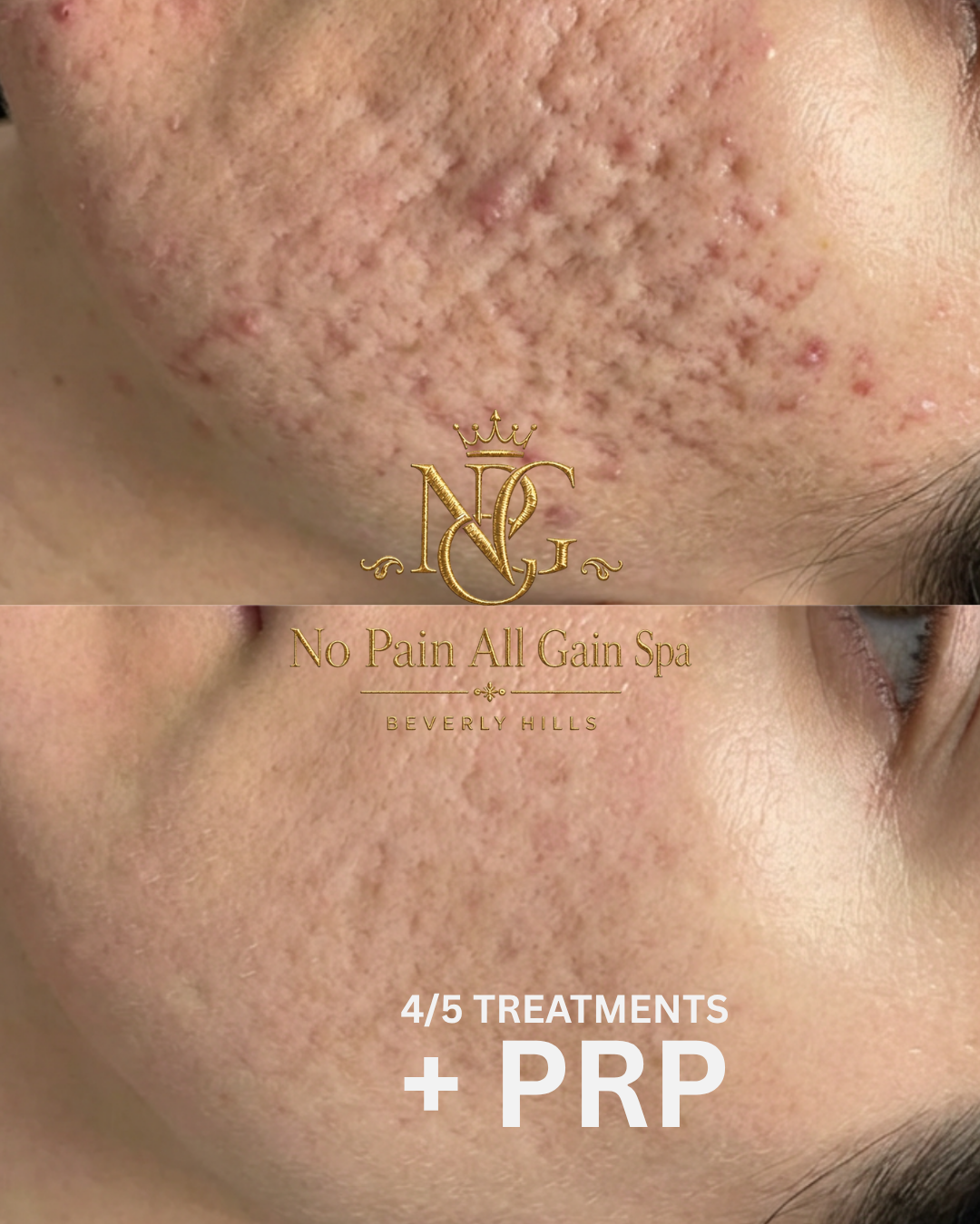 Close-up of a person's cheek showing improvement in skin texture; before and after skincare treatments, including PRP. Text indicates 4 of 5 treatments completed with no pain at No Pain All Gain Spa in Beverly Hills.