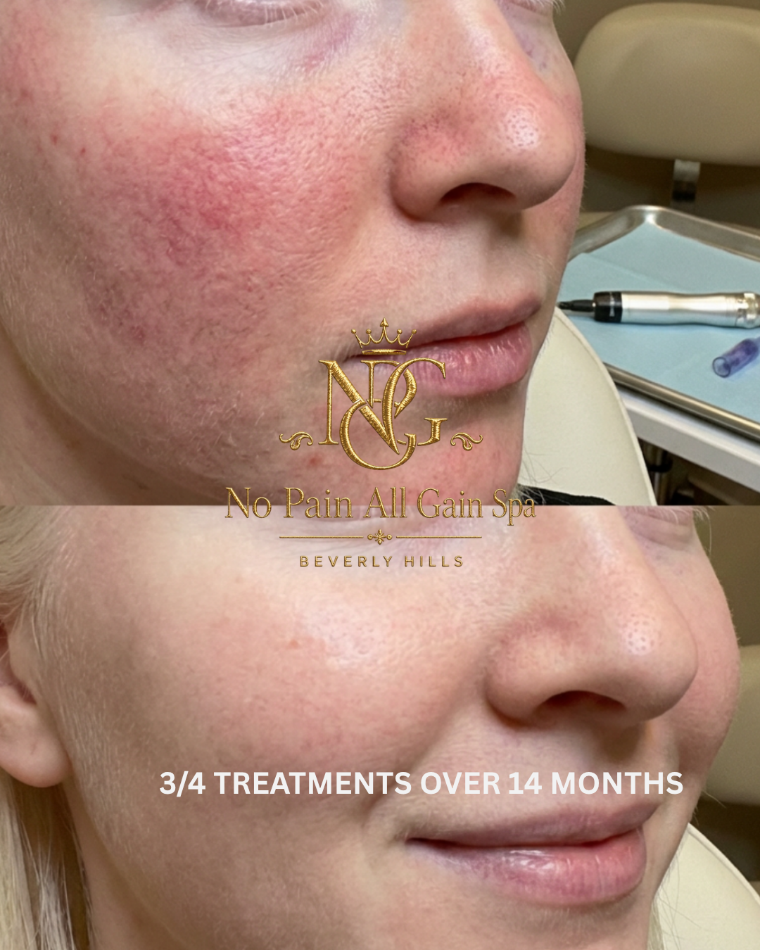 Close-up photos showing the improvement of skin texture, from redness and unevenness to smoothness, after 3-4 treatments over 14 months at No Pain All Gain Spa in Beverly Hills.