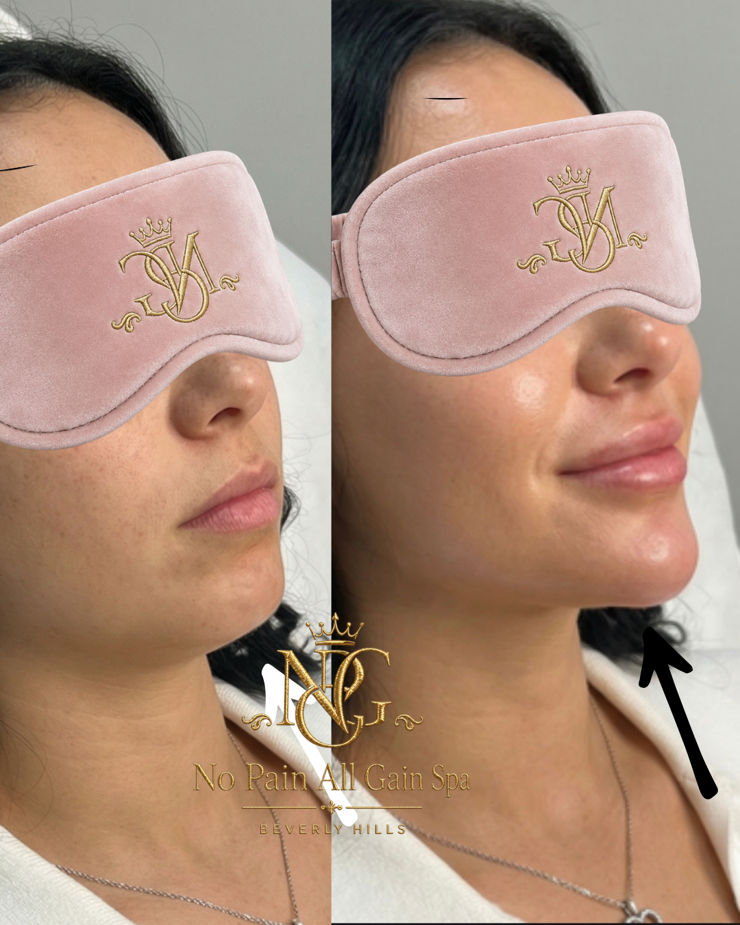 Side-by-side comparison of a woman's face before and after a skincare treatment, with a pink sleep mask covering her eyes in both images. The after photo shows brighter, clearer skin and a slight smile.