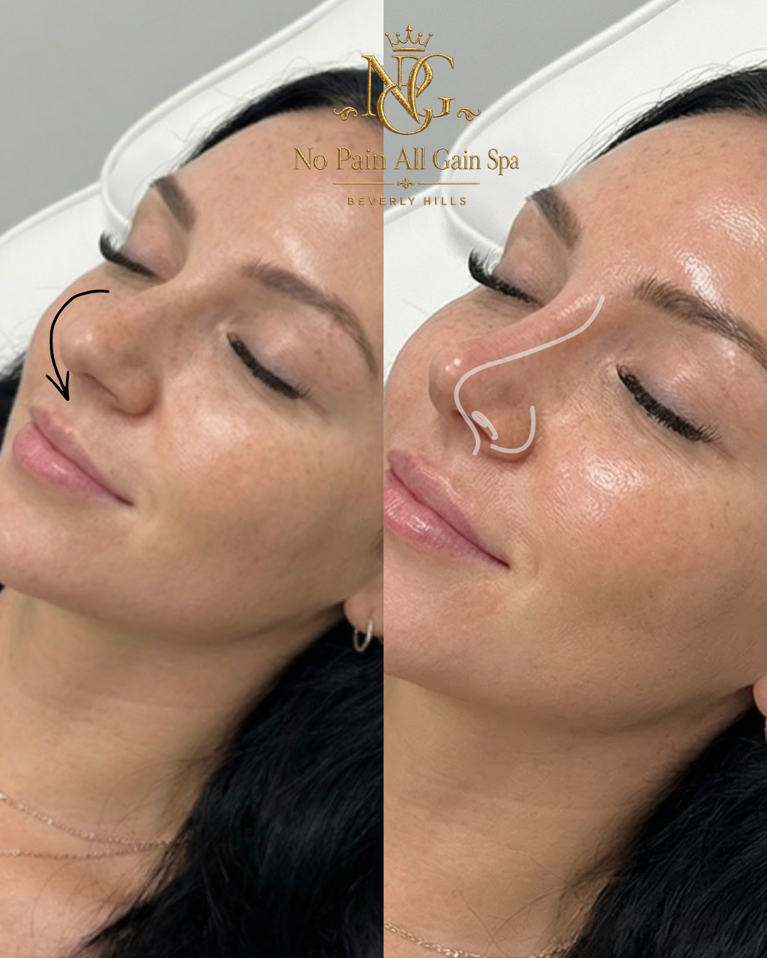 A side-by-side comparison of a woman before and after a cosmetic procedure at No Pain All Gain Spa in Beverly Hills, showing improved skin texture around the nose and cheek area.