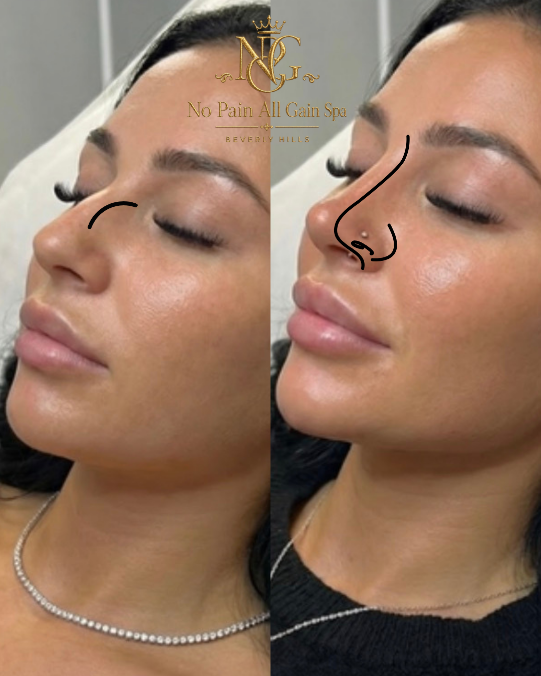 Side-by-side comparison of a woman's face before and after a cosmetic procedure, showing changes in her nose with added sketches to highlight the differences.