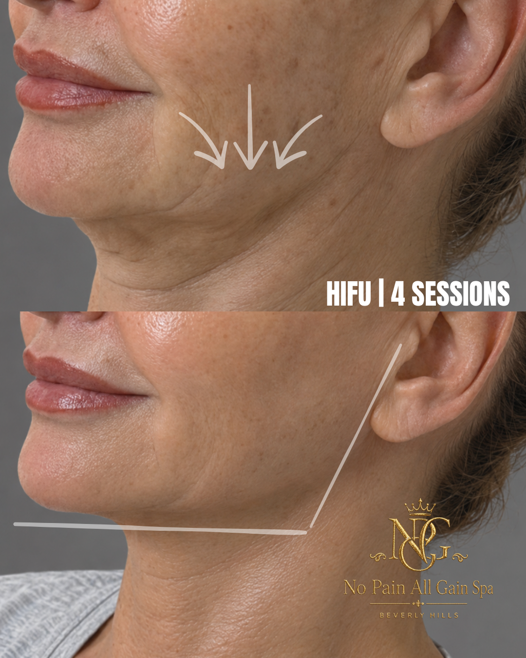 Side-by-side comparison of a woman's jawline and cheek before and after 4 sessions of high-intensity focused ultrasound (HIFU) treatment. The after photo shows smoother skin and reduced sagging.