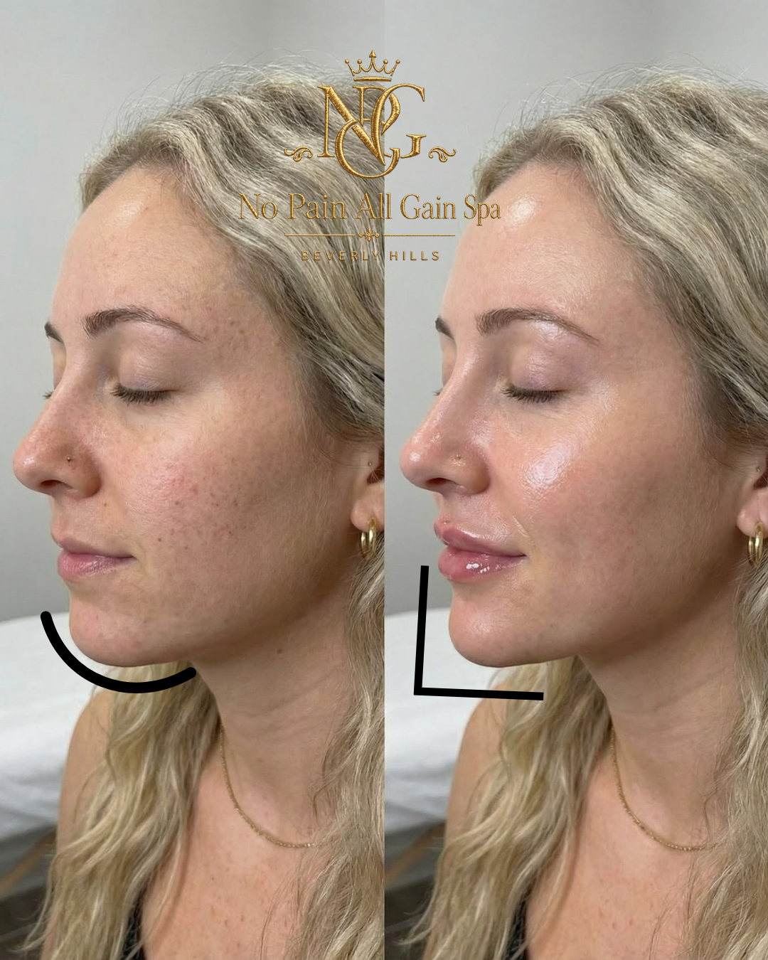 Comparison photo of a woman's face before and after skincare treatment, showing improved skin texture and glow, with logo and text for No Pain All Gain Spa Beverly Hills.