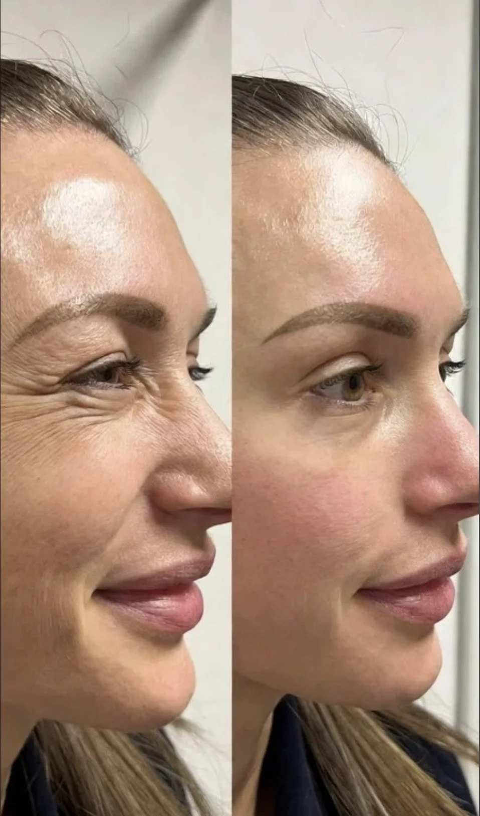 Side-by-side photos showing a woman's face before and after cosmetic procedure, with visible reduction in wrinkles and more defined eyebrows.