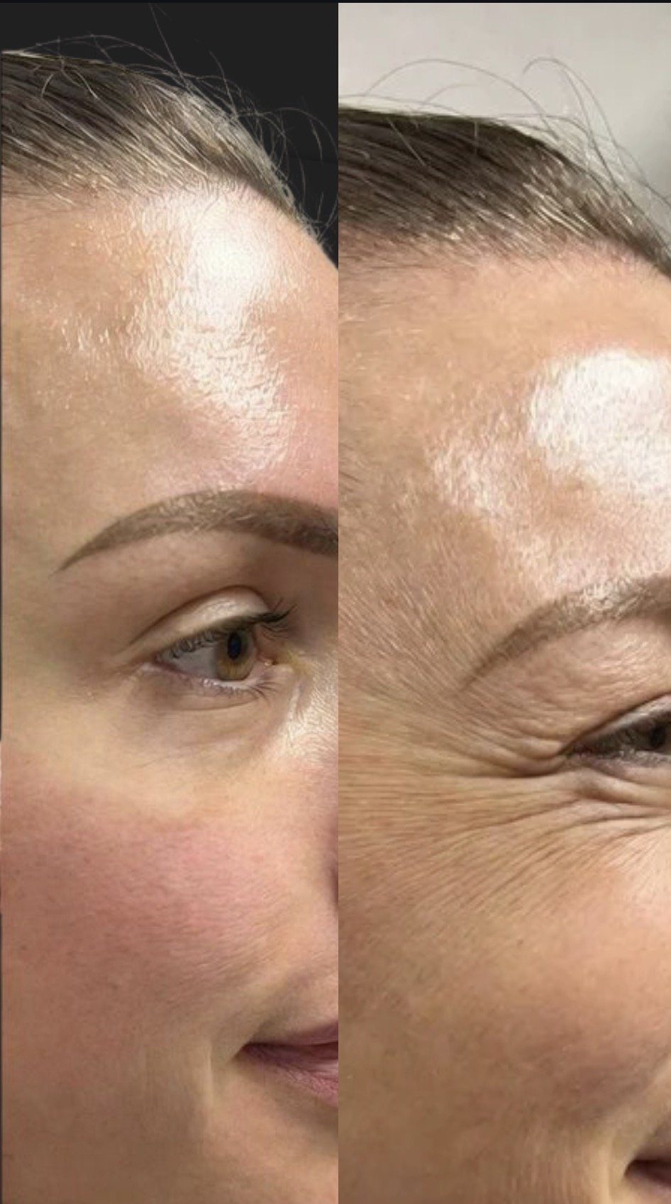 Comparison of two close-up images of a woman's forehead, one showing recent skincare or treatment results with smooth, shiny skin, the other showing aged or less treated skin with wrinkles and less shine.