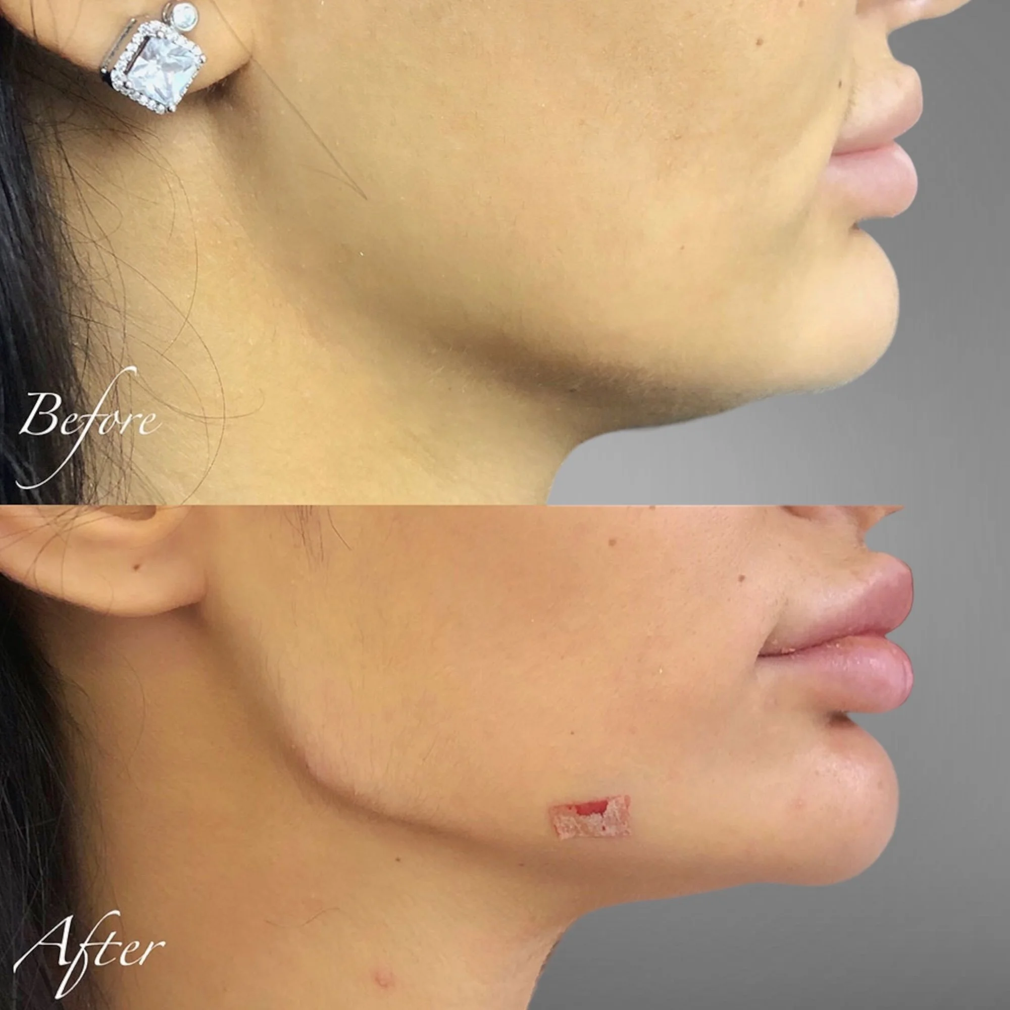 Side profile of a woman's face showing improvements after a cosmetic procedure with clear skin and a small bandage on her chin.
