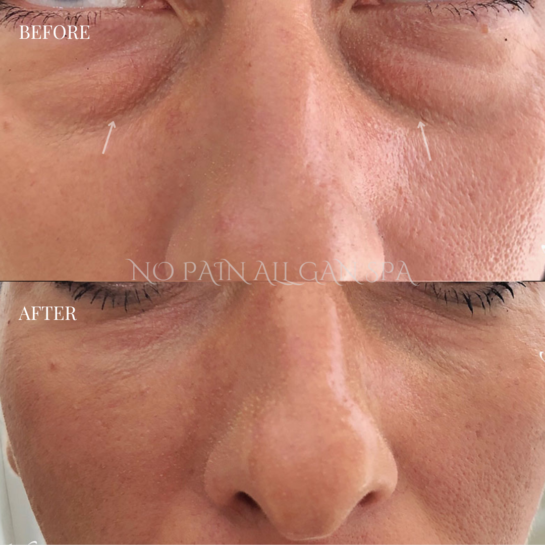 Close-up of a person's nose and surrounding skin, showing before and after images of skin treatment, with improved skin texture and reduced pores in the after photo.