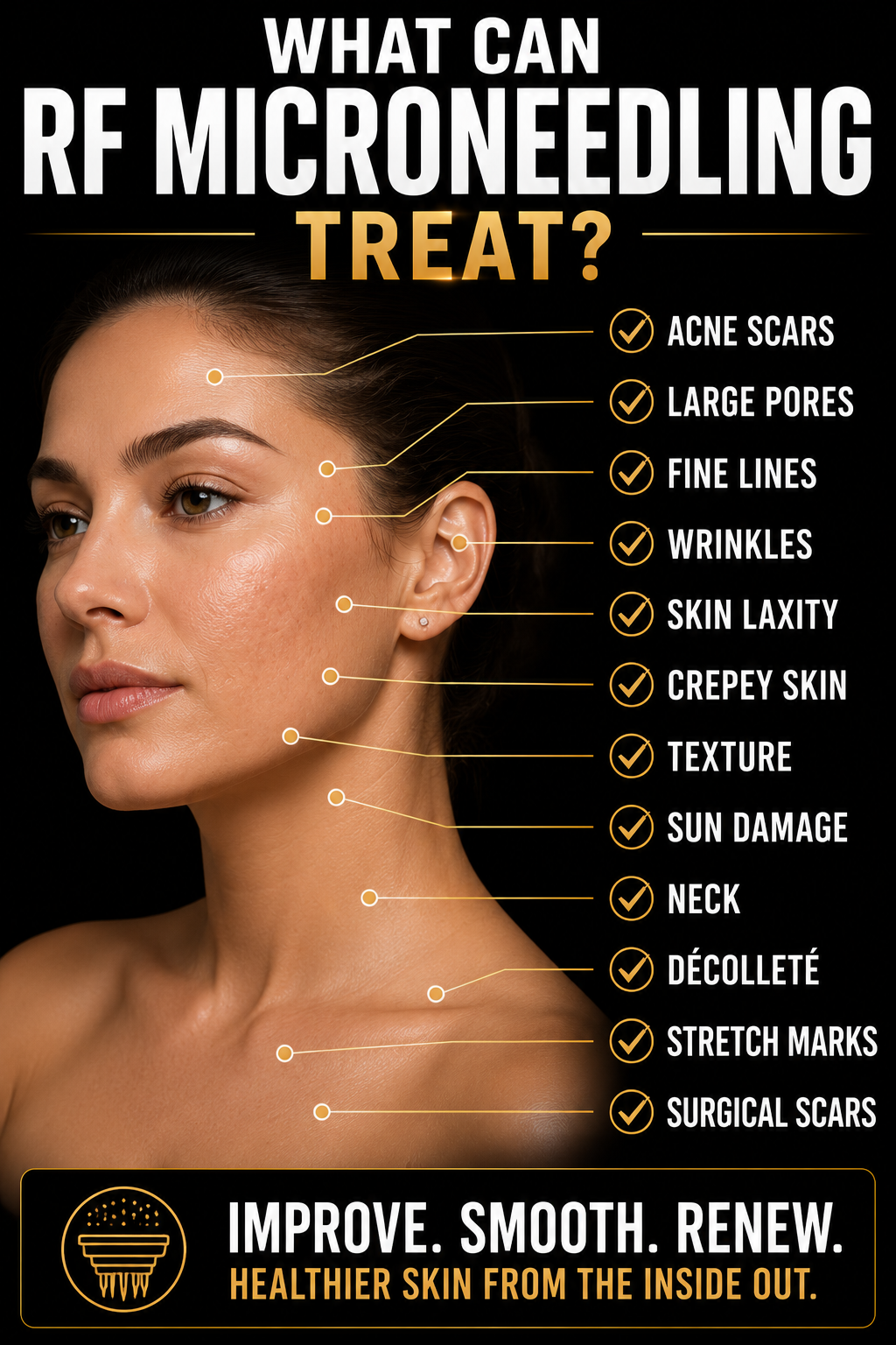 A woman with clear skin, labeled with different skin concerns like acne scars, large pores, fine lines, wrinkles, skin laxity, crepey skin, texture, sun damage, neck, décolleté, stretch marks, and surgical scars. The image promotes using RF microneedling treatment for healthier skin from the inside out.