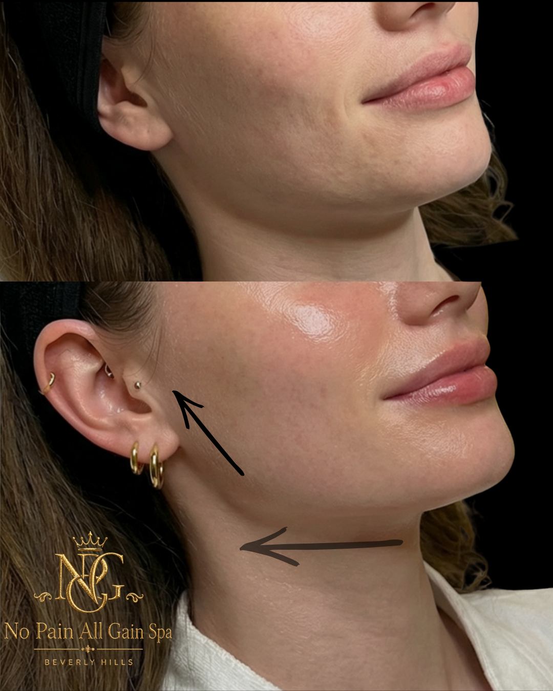 Before and after images of a woman's jawline and cheek area showing reduction in skin imperfections and improved contour. The 'after' image shows smoother, more lifted skin with visible jewelry on her ear.