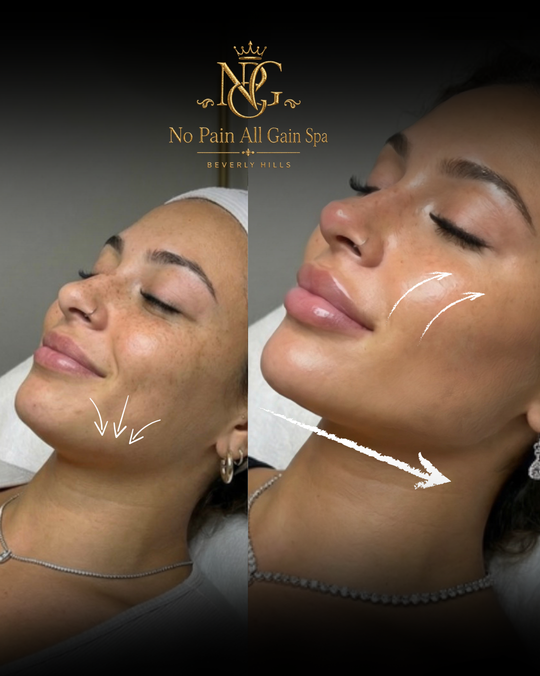Side-by-side before and after images of a woman receiving a cosmetic treatment at No Pain All Gain Spa in Beverly Hills, showing improved skin smoothness and contouring.