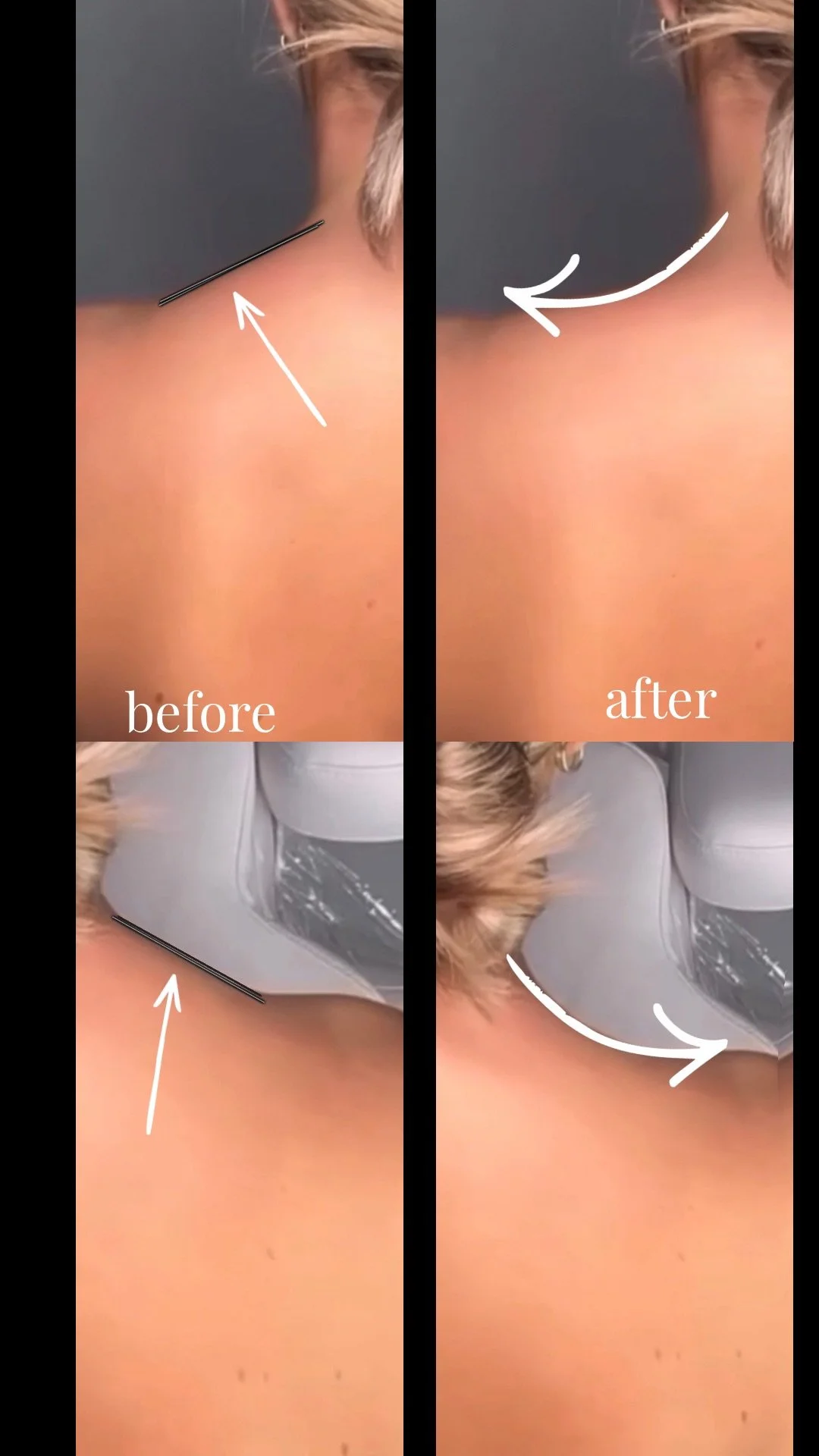 Close-up of a person's neck showing a before and after comparison of a medical or cosmetic procedure, with arrows indicating the area.