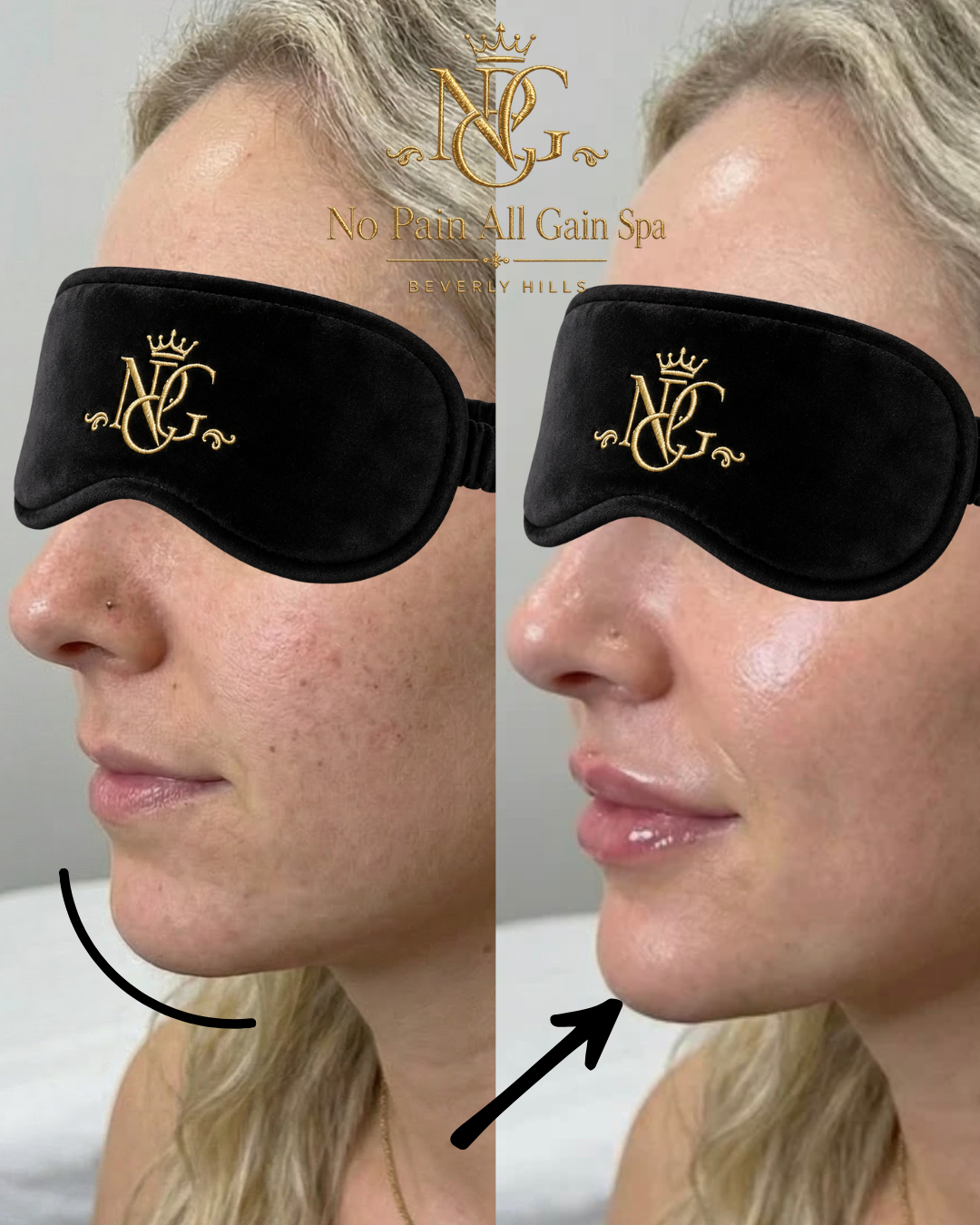 Side-by-side comparison of a woman before and after skincare treatment, wearing a blackout eye mask with a gold logo from No Pain All Gain Spa in Beverly Hills. The woman shows improved skin clarity and smoothness after treatment.