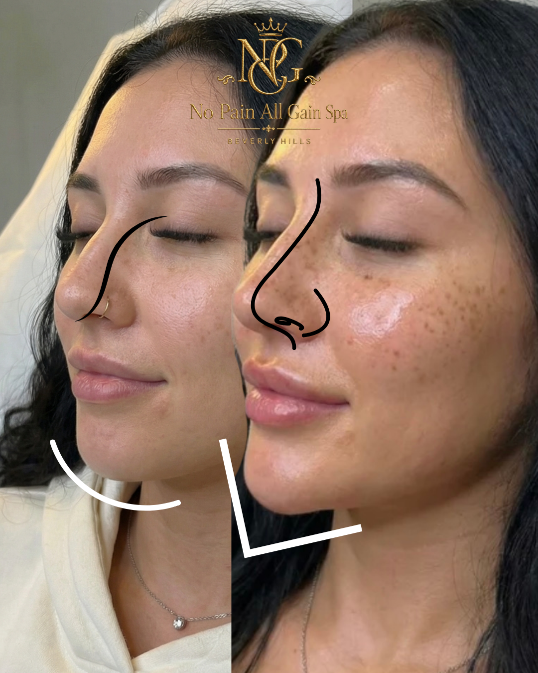Side-by-side comparison of a woman's face before and after a cosmetic procedure at No Pain All Gain Spa in Beverly Hills, with drawn lines illustrating the changes in nose and facial contours.