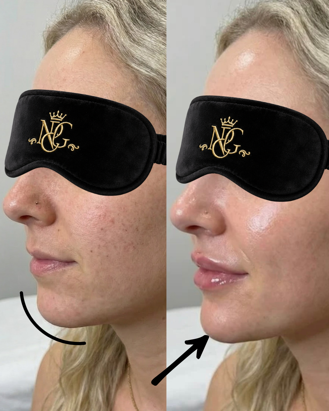 Side-by-side before and after photos of a woman with black eye mask with gold embroidery. The before photo shows her with skin imperfections, while the after shows smoother, clearer skin and slightly fuller lips.
