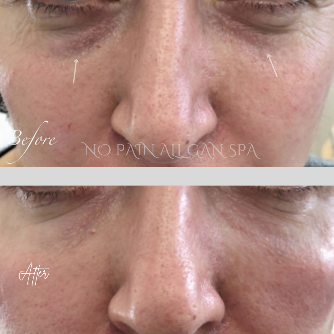 Close-up images of a person's face showing the area around the nose and cheeks before and after skin treatment, highlighting reduced redness and improved skin texture.
