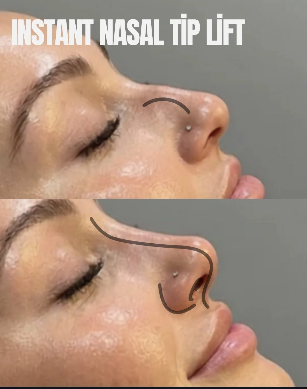 Comparison of a person's nose before and after a nasal tip lift procedure, showing the change in the nasal shape outlined with black lines.