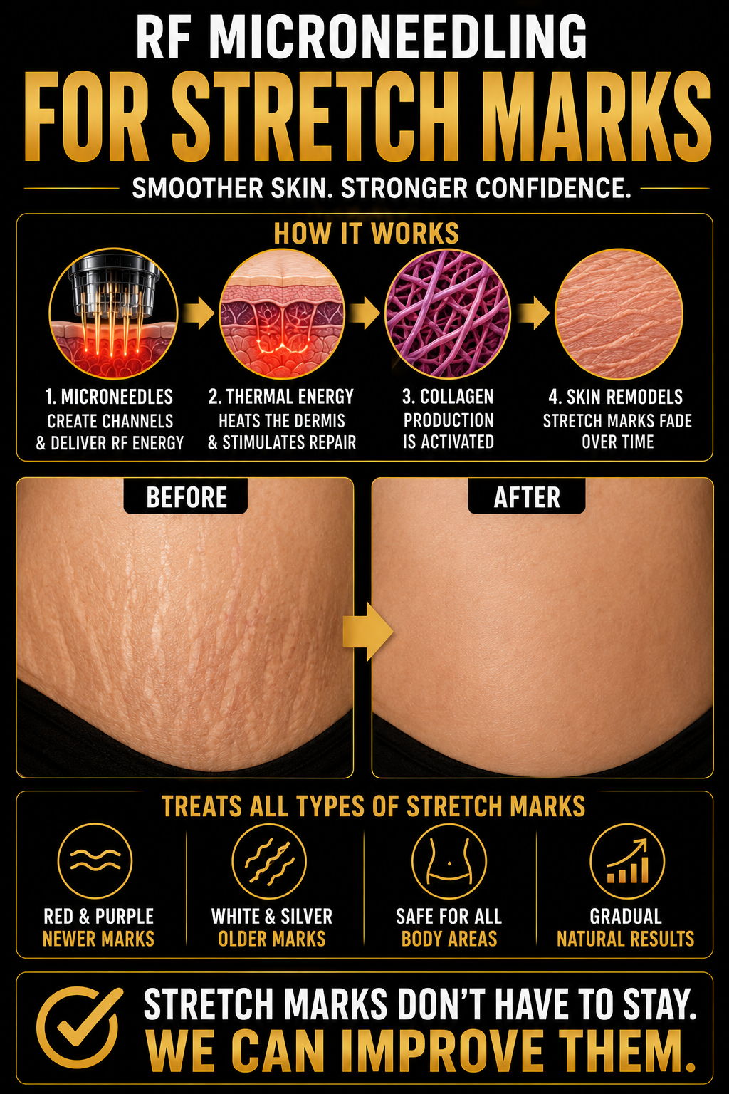 Infographic explaining RF microneedling for stretch marks with before and after photos. The process involves creating channels with microneedles, heating the dermis, activating collagen production, and fading stretch marks over time. The before photo shows textured stretch-marked skin, and the after photo shows smooth skin. The treatment is suitable for all skin types, safe for all body areas, and provides gradual, natural results.