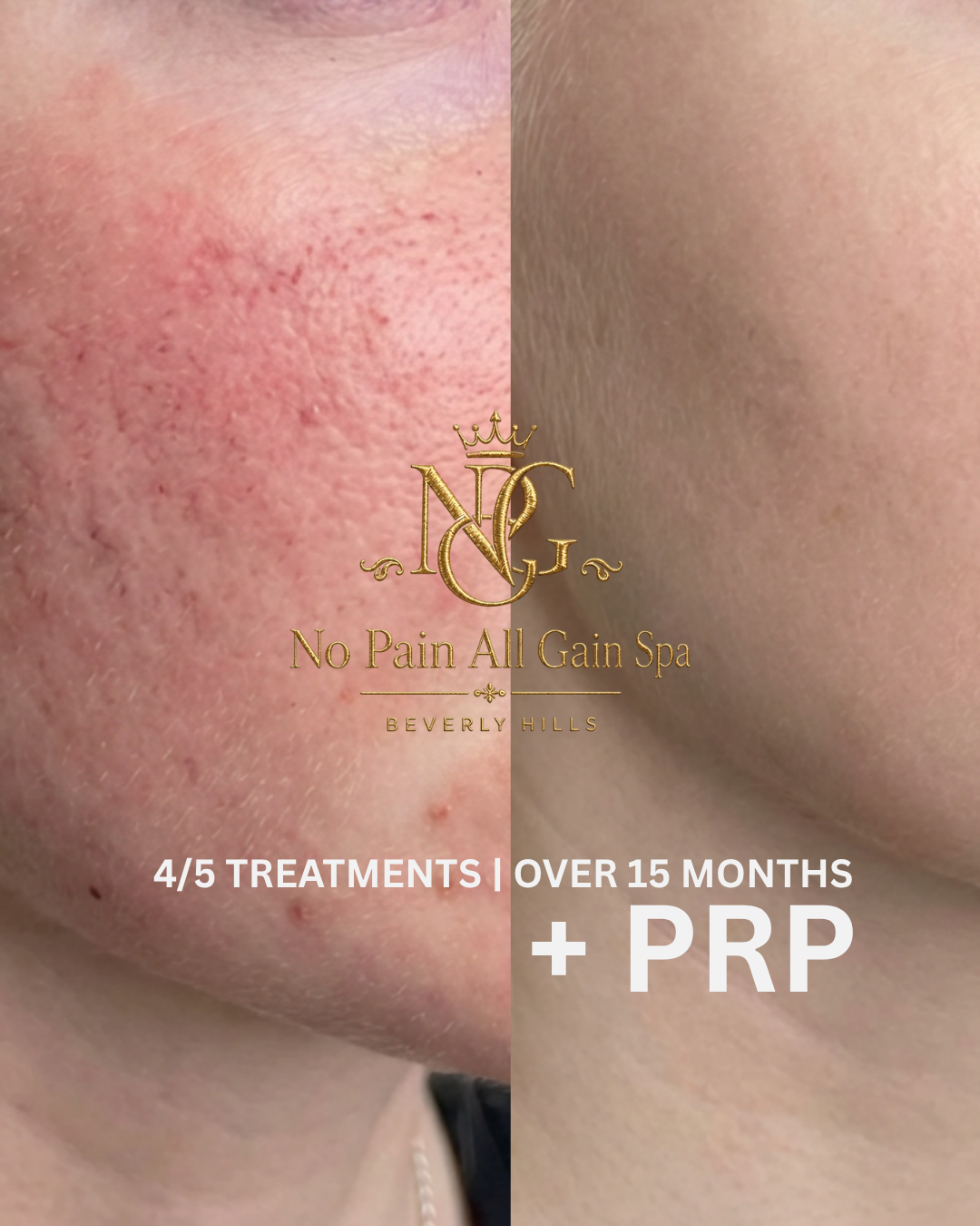 Before and after images of skin treatment showing reduction in redness and skin texture improvement, with logo of No Pain All Gain Spa Beverly Hills and promotional text about skin treatments.