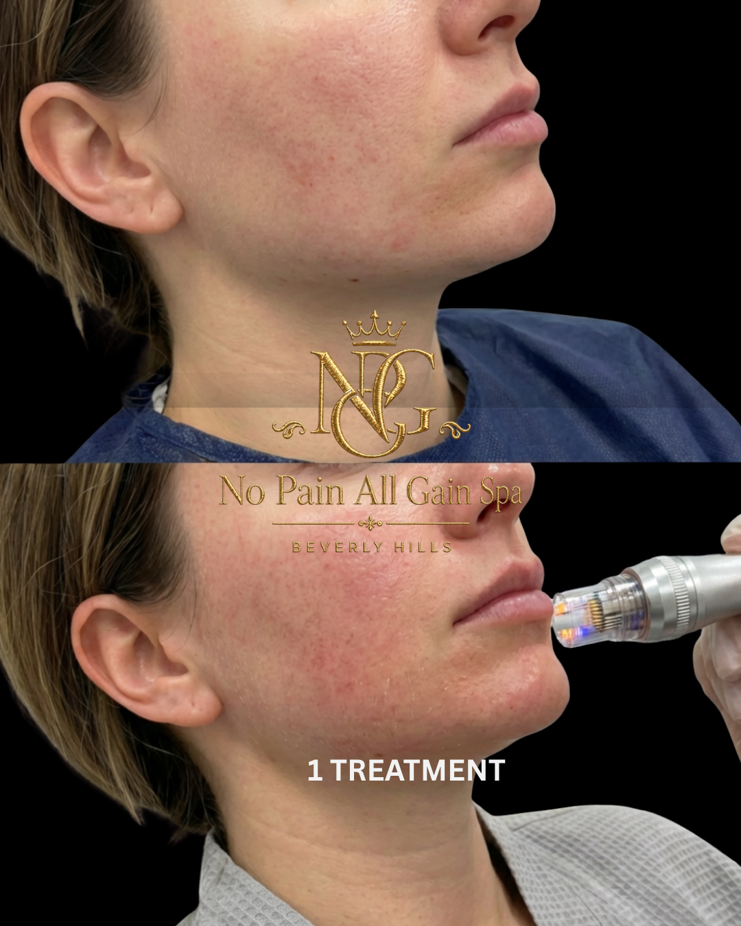 Before and after images showing a woman's face with skin redness, with the after image showing improved skin after a treatment at No Pain All Gain Spa in Beverly Hills, using a micro-needling device. Text overlay indicates one treatment. The spa's lo