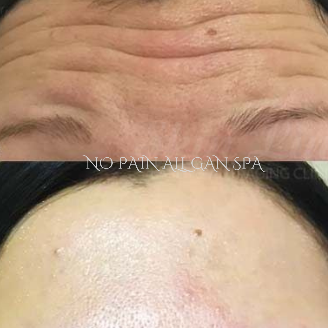 Before and after images showing a forehead with wrinkles and a smooth forehead after treatment, with the text 'NO PAIN ALL GAIN SPA' overlaid.