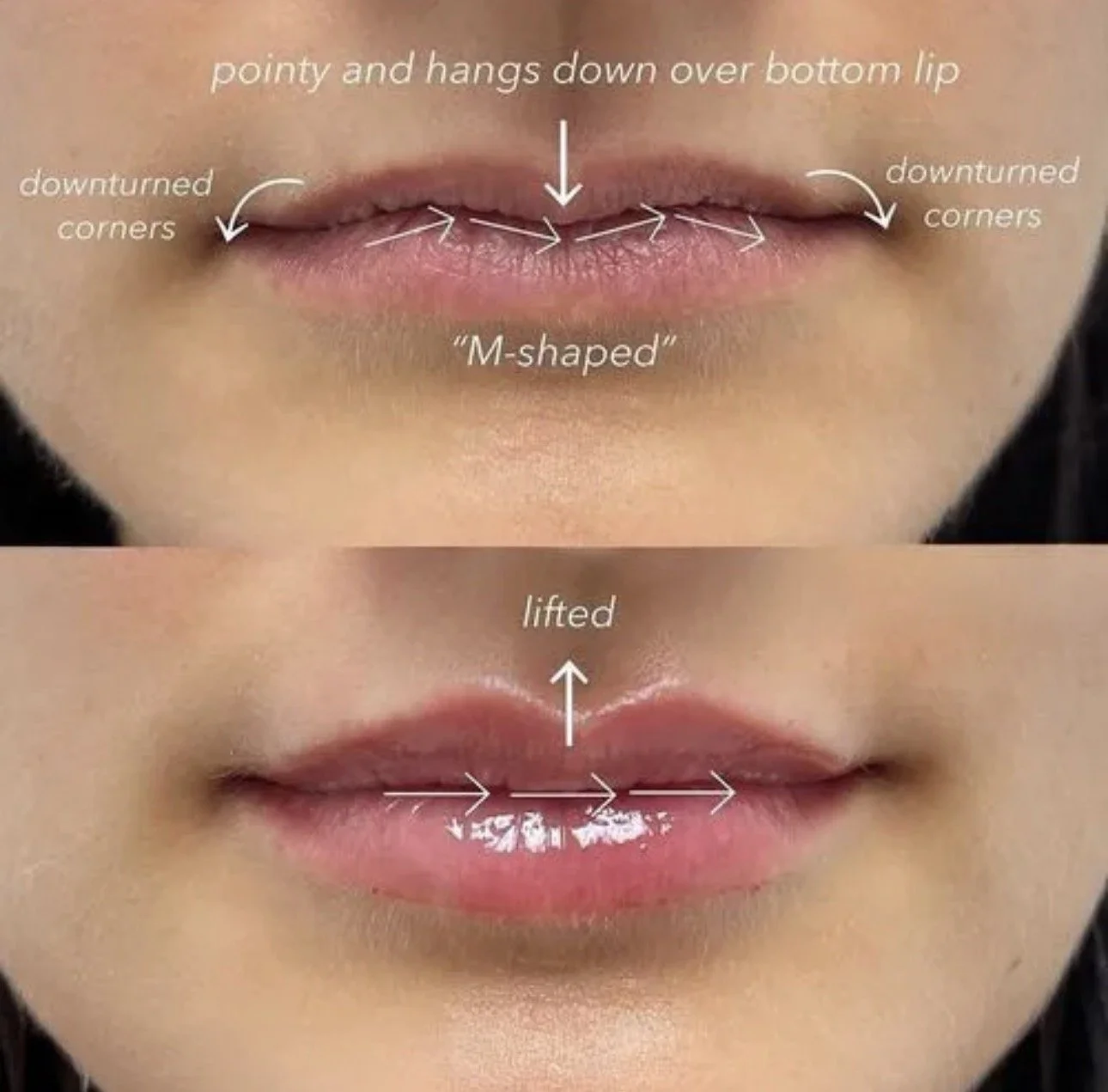 Comparison of lips before and after lifting, showing detailed annotations of lip shape, with labels indicating 'pointy and hangs down over bottom lip', 'downturned corners', and 'M-shaped'. The bottom image shows the lips lifted with a smooth, plump 