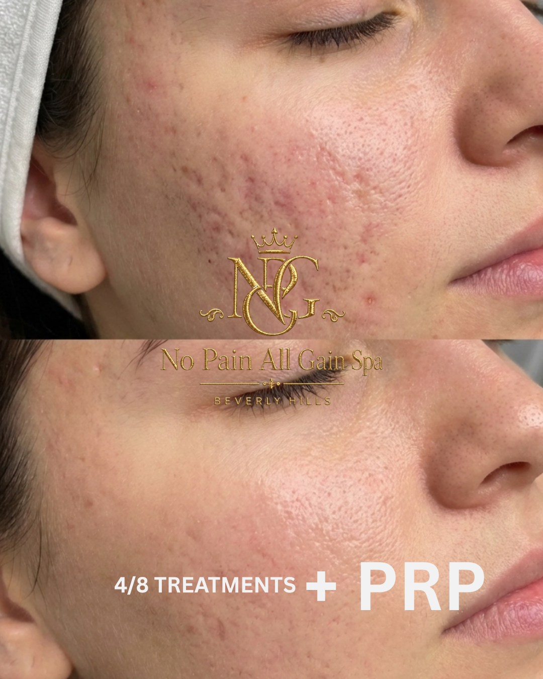 Side view of a woman's face showing the before and after results of acne scar treatment, with improved skin texture and reduced scarring shown in the after photo. The image advertises No Pain All Gain Spa in Beverly Hills and mentions 4 treatments pl