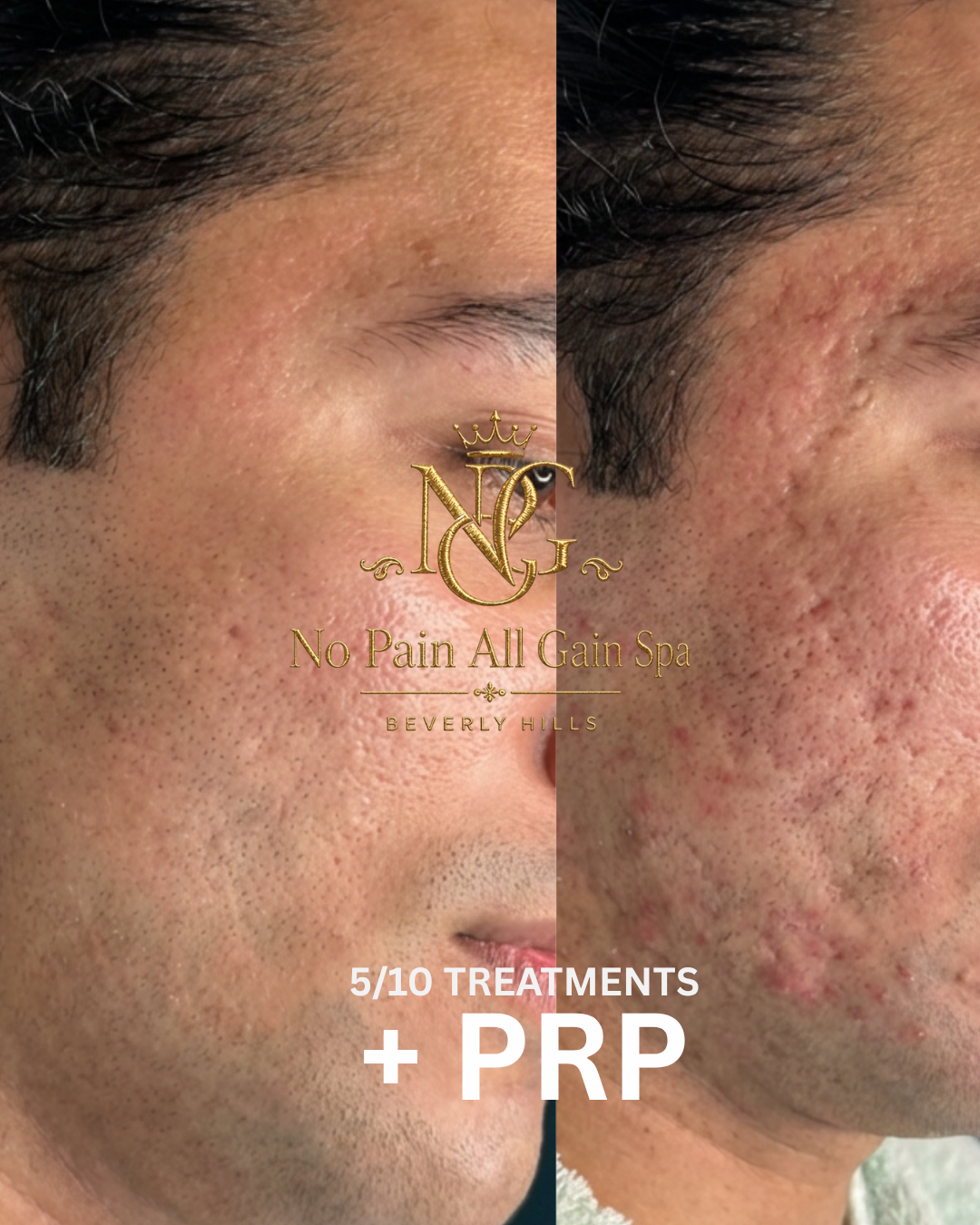 Comparison of a man's face showing skin before and after skincare treatment, with the left side appearing clearer and the right side showing acne scars and redness. Overlay text indicates '5/10 treatments + PRP' from No Pain All Gain Spa in Beverly H