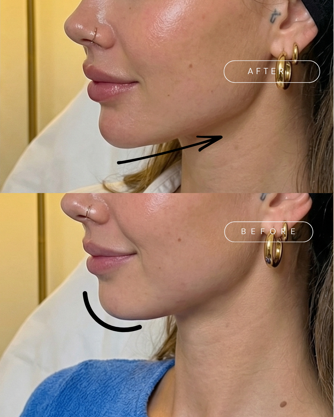Side-by-side comparison of a woman's profile before and after a cosmetic procedure, showing a more defined chin and jawline in the 'after' image.
