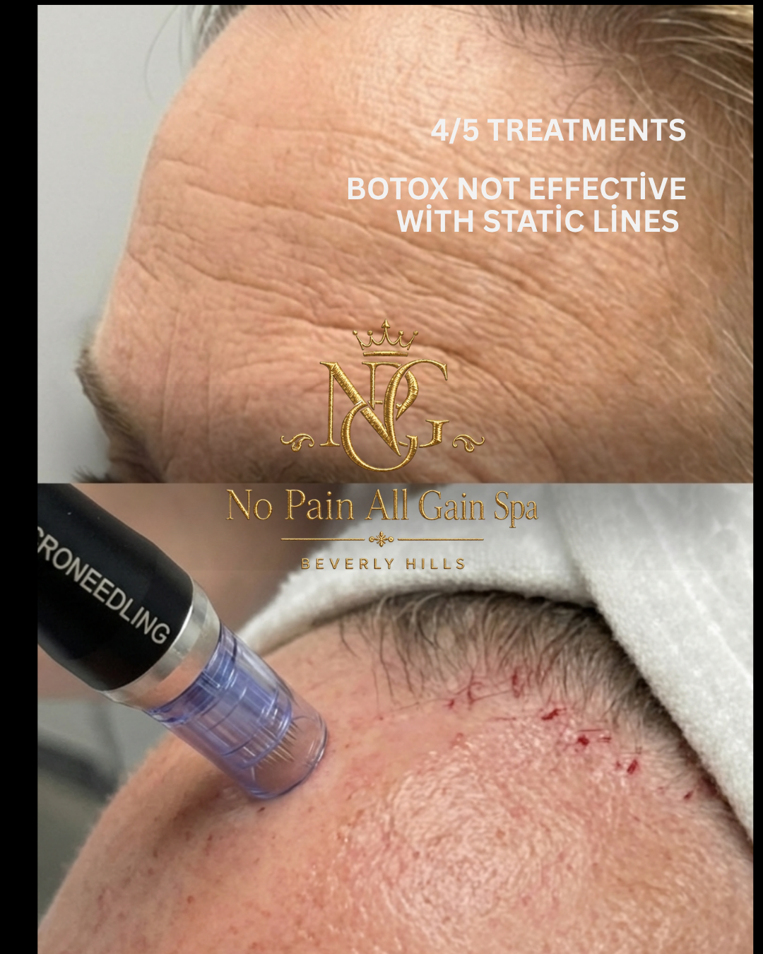 Close-up of a woman's forehead showing wrinkles and lines, with text indicating four out of five treatments with Botox are ineffective for static lines, and a second image of a facial treatment with a microneedling device on the skin.