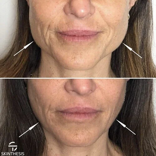 Comparison photo showing a woman's face with and without signs of aging, including wrinkles around the mouth and cheeks.