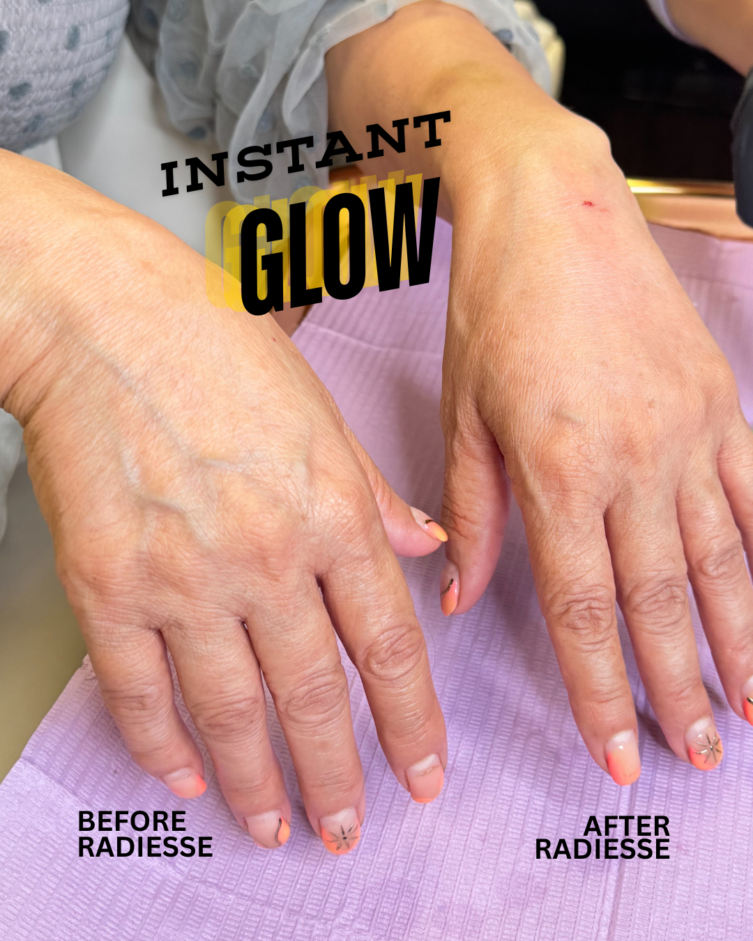 Comparison of hands before and after Radiesse cosmetic treatment showing improved skin smoothness and volume, with the words 'Instant Glow' overlayed.