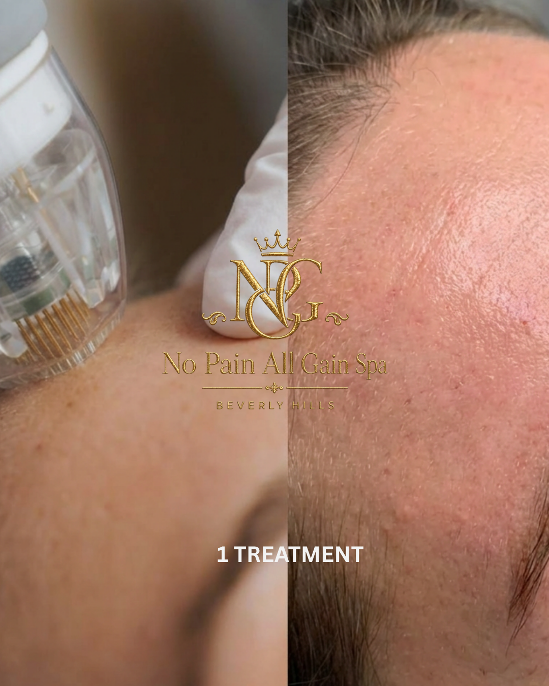 Side-by-side comparison of a person's face before and after a skincare treatment at No Pain All Gain Spa, Beverly Hills, showing improved skin texture after one treatment.