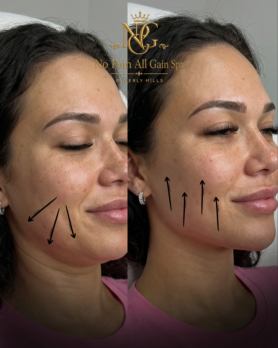 Close-up of a woman's face showing before and after results of a skin treatment at No Pain All Gain Spa in Beverly Hills, with arrows pointing to improved skin texture and reduction of pigmentation.